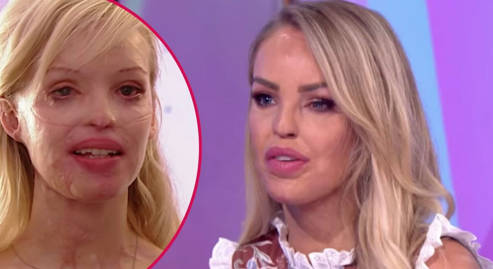 Inside Katie Piper’s health issues following acid attack - more than 250 operations; secret sepsis battle; hair transplant; eye removal